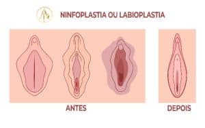ninfoplastia cirurgia intima labioplastia antes e depois marabá pará