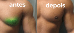 O que é ginecomastia? resultado de uma ginecoplasia