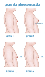 Ginecomastia e Anabolizantes como resolver com cirurgia - Dr. André PAese Imperatriz Marabá