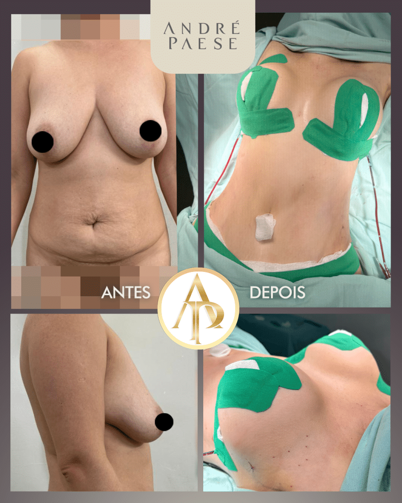 combinar cirurgias plasticas em maraba abdominoplastia mini abdomen lipo lipoescultura enxerto gluteo masto pexia com silicone nos seios