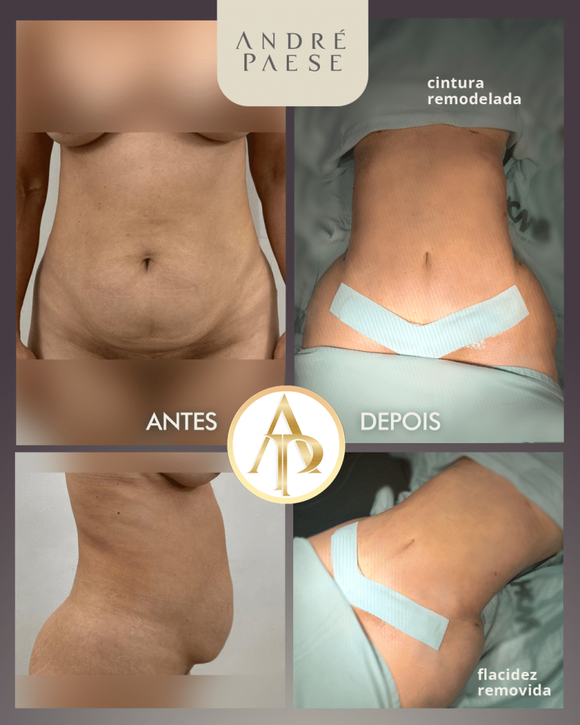 mini abdomen abdome eliminar a flacidez da barriga abdonoplatia abdominoplastia cirurgia plastica pará 