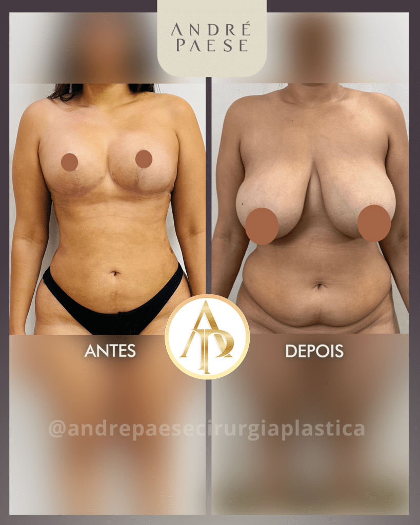 lipoaspiracao lipoescultura pele cirurgiao plastico em maraba para clinica de estetica