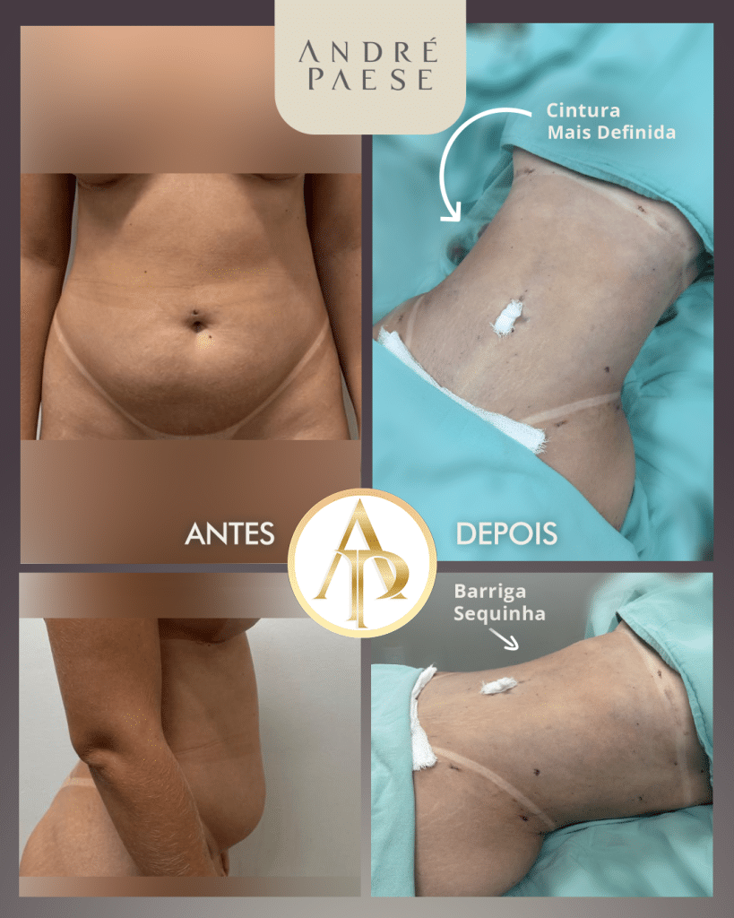 Miniabdome miniabdominoplastia abnoplastia lipo lipoescultura ante e depois clinica cirurgia plastica maraba combinar cirurgias