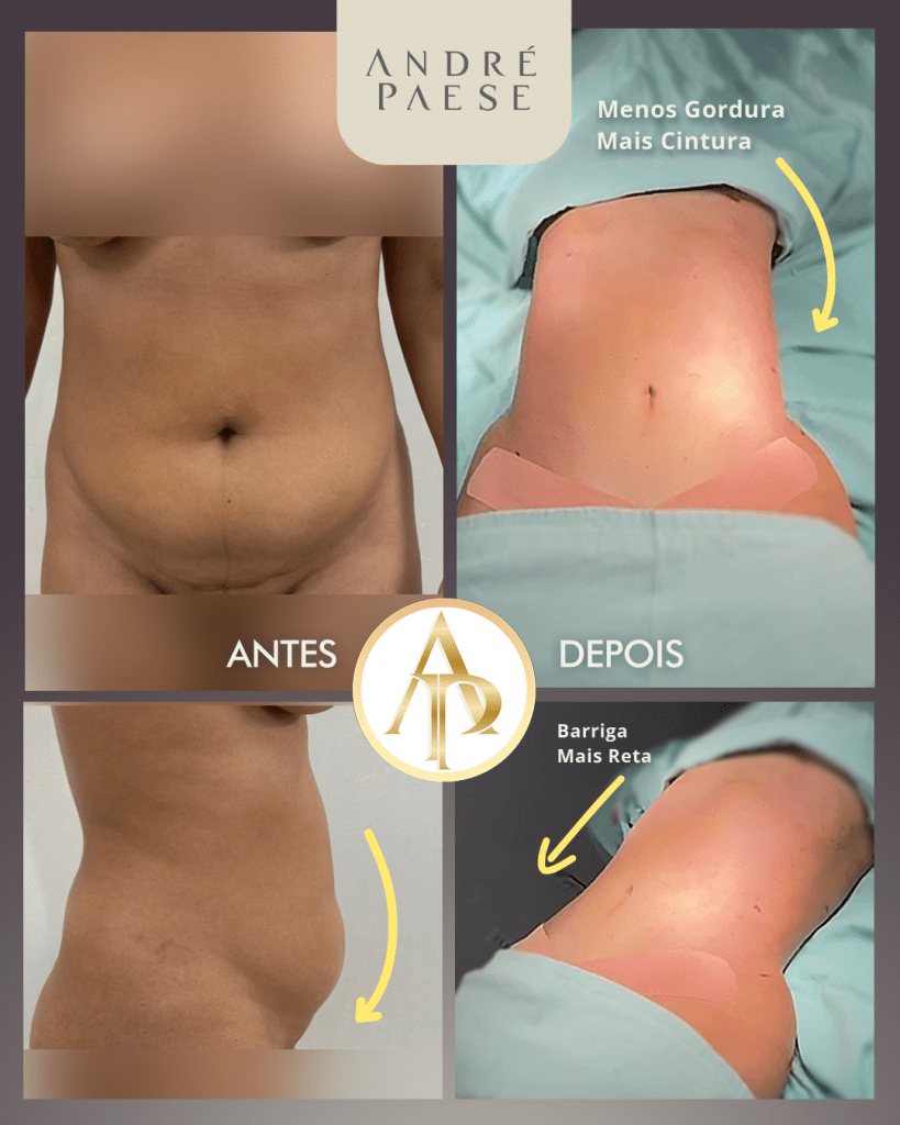 mini abdomen miniabdominoplastia lipoescultura combinar cirurgias maraba pará cirurgiao plastico clinica de estetica antes e depois