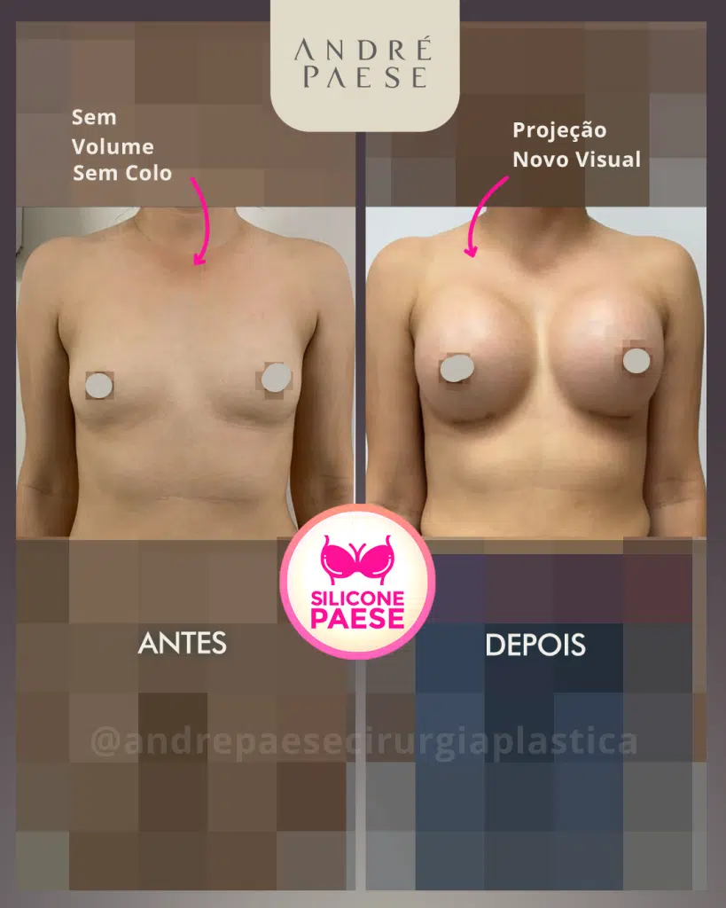Antes e depois resultado silicone mamoplastia de aumento cirurgia plastica marabá Dr. André Paese