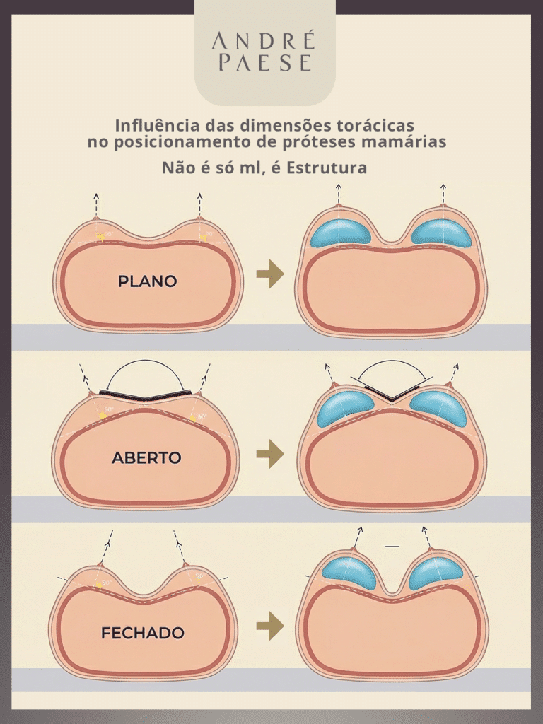 Posicionamento de próteses mamárias explicado