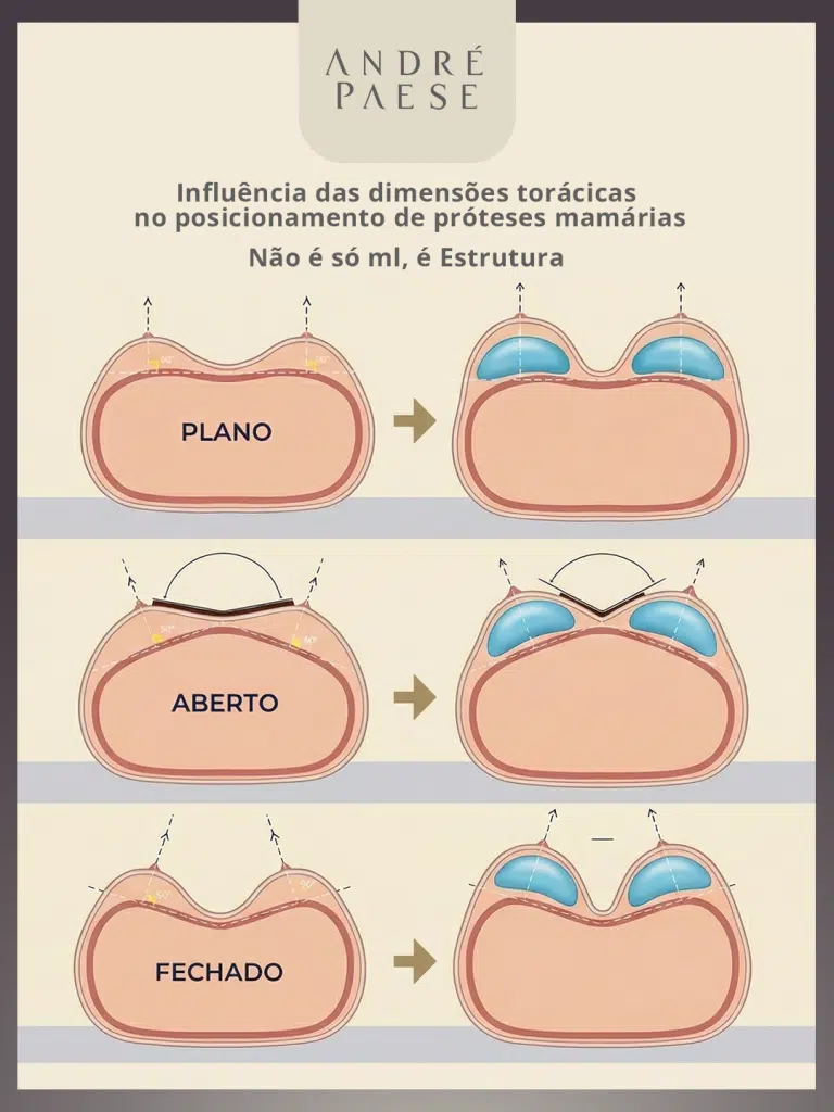 Posicionamento de próteses mamárias explicado