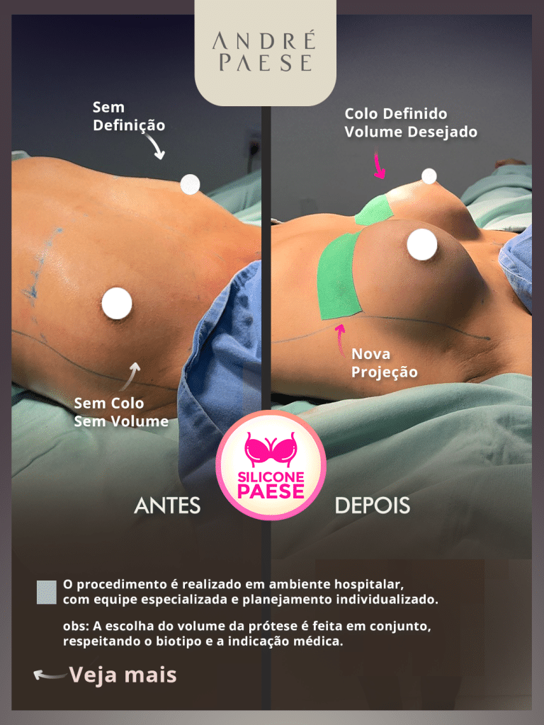 Antes e depois de cirurgia estética.
