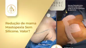 Valores Redução de Mama em 2026 Marabá