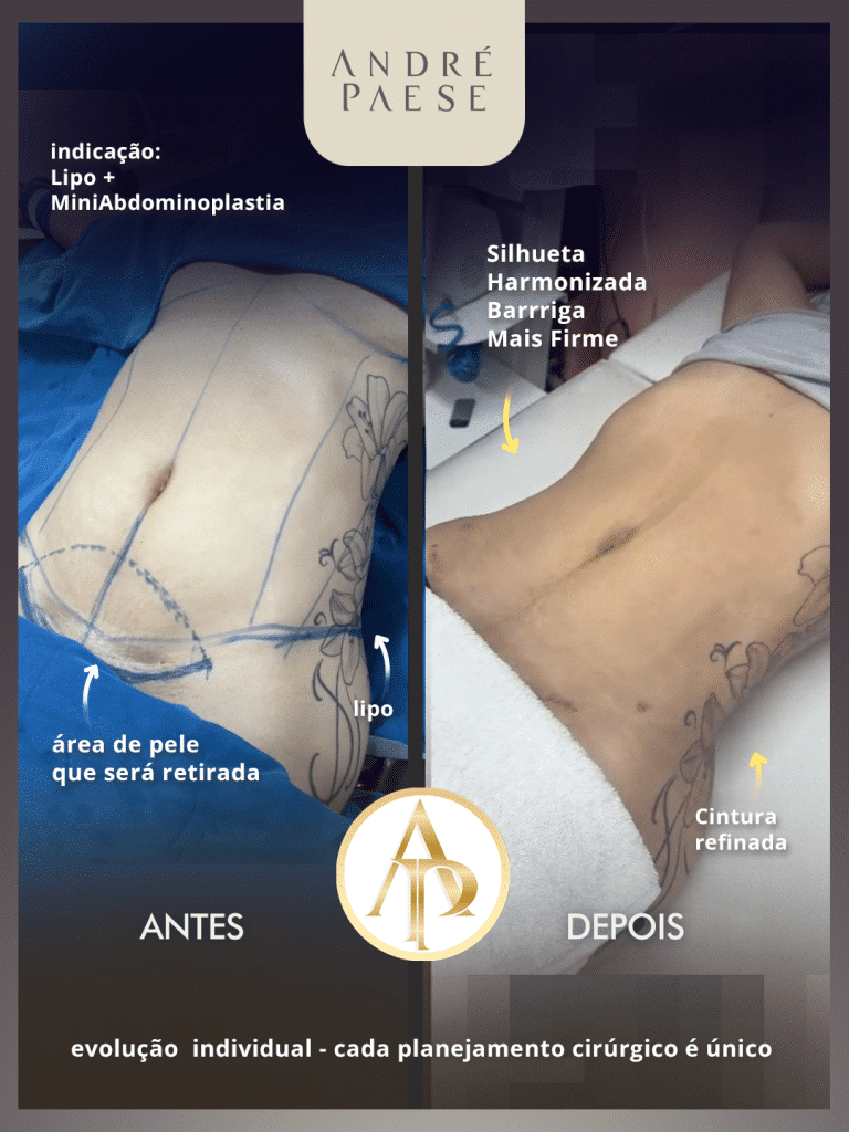 mini lipo abdominoplastia cirurgiao plastico maraba andre paese melhor marabá tucurui parauapebas novo repartimento imperatriz carajas
