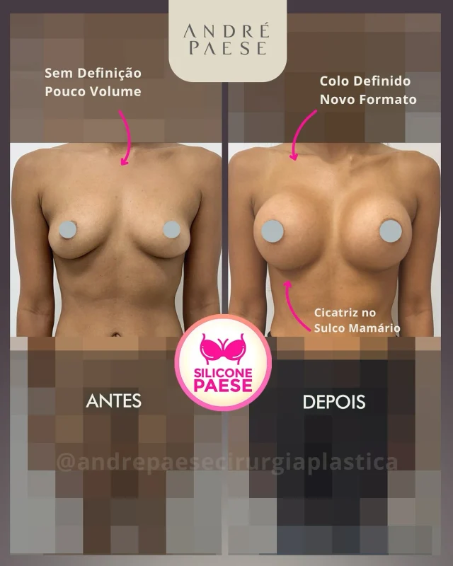 ❤️A mamoplastia não se resume apenas ao aumento das mamas: ela traz harmonia, valoriza o contorno corporal e, principalmente, renova a autoestima. É uma transformação que vai além da aparência, refletindo em cada detalhe da vida da mulher. 🙏😀

⁉️Quantos ml você acha que ela colocou?