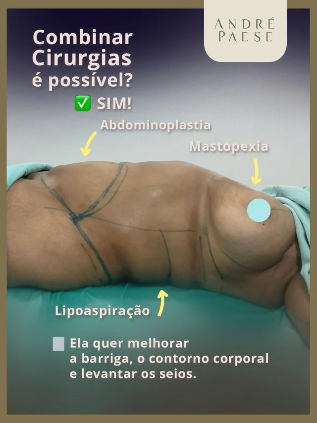🙏Em alguns casos, é possível combinar cirurgias como abdominoplastia, lipoaspiração e mastopexia sem silicone, trazendo resultados ainda mais harmônicos.

Essa associação ajuda a devolver mais firmeza ao abdômen, levantar e reposicionar as mamas e eliminar as gorduras localizadas que tanto incomodam

O Dr. André Paese realiza um planejamento individualizado para cada paciente.

O resultado? Um corpo mais leve, harmonioso. Agora é se cuidar para que o resultado melhore cada vez mais.