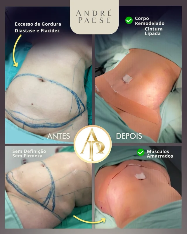 ✅ Com a Lipo+Abdominoplastia, foi possível retirar o excesso de pele, corrigir a musculatura enfraquecida e remodelar toda a região abdominal. O corpo ganhou contorno definido, cintura marcada e mais firmeza que antes não existia.

Essa paciente apresentava excesso de gordura abdominal, flacidez intensa e diástase dos músculos retos do abdômen — uma condição comum após gestação ou grandes variações de peso.

O resultado é uma transformação bem expressiva, devolvendo autoestima à paciente.

⁉️Você faria essa cirurgia? Tem vontade de ficar com a barriga mais retinha e chapada!?