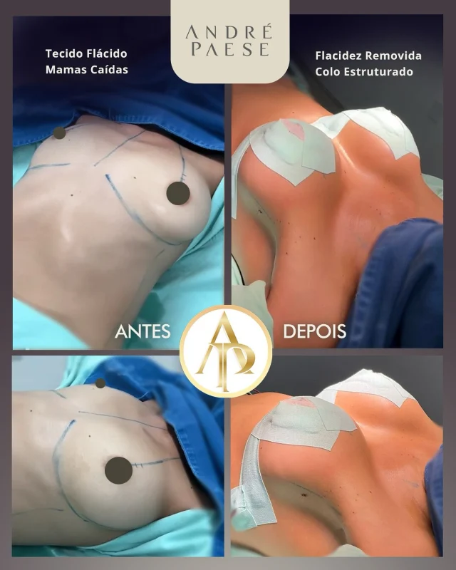 ⁉️Pra você qual foi esse tamanho? Diz nos comentários 😊 Poucas pessoas acertam de primeira :) 

O resultado é um colo firme, seios bem projetados e uma transformação que vai além da estética: a realização de um sonho e o resgate da confiança em si mesma.

✅ Com a mastopexia associada à prótese, o Dr. André Paese retirou o excesso de pele, reposicionou as aréolas e devolveu volume e sustentação. Que ela estaja contente com esse resultado.