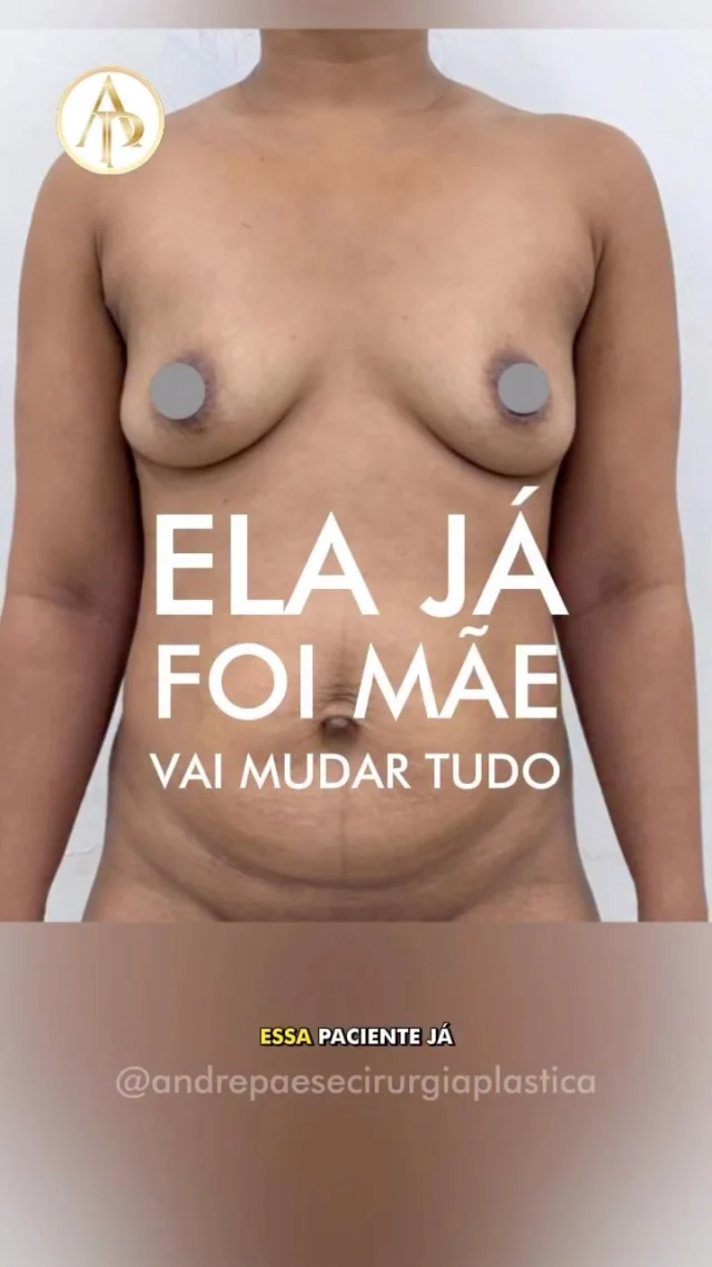 Uma Transformação completa após a maternidade

Essa paciente já foi mãe e, com o tempo, o corpo passou por mudanças: a pele do #abdomen se esticou, os músculos enfraqueceram e os seios perderam volume e sustentação.

O Dr. André Paese realizou uma #lipo #abdominoplastia combinada com mastopexia com prótese, devolvendo firmeza ao abdômen, marcando novamente a cintura e remodelando as mamas com colo definido e natural.

O resultado é um corpo mais equilibrado, contornos harmônicos e a sensação de se reencontrar com uma melhor versão. 🙏✨