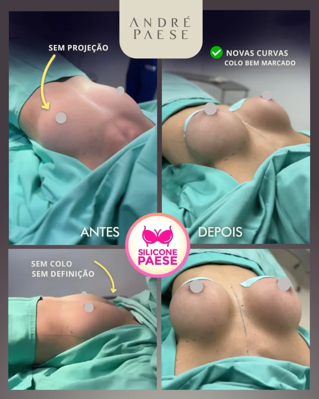 Ela queria muito essa mudança. Com o Dr. André Paese ela conseguiu realizar o sonho de colocar silicone. A cirurgia é super tranquila e dura menos de 30min. 

Agora ela tem um colo bem definido e o volume ideal que valorizou ainda mais sua beleza. 

❤️Qual seria o tamanho dessa prótese? Consegue descobrir?