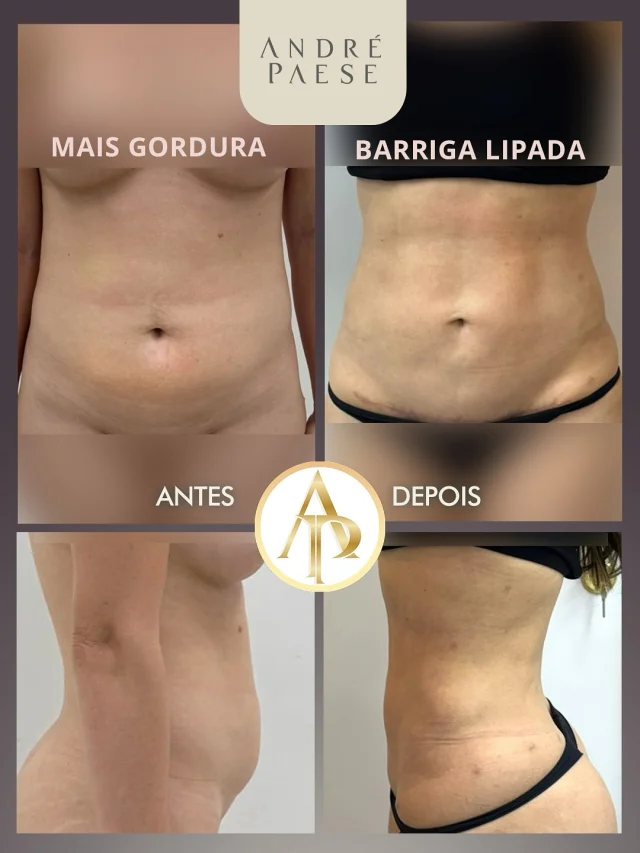 Essa paciente queria melhorar a aparência do abdômen e deixar a sua musculatura mais aparente, com um contorno mais harmonioso e natural.

O Dr. André Paese realizou uma lipoescultura bem refinada, associada a um miniabdômen, ajustando cada detalhe para realçar as curvas e valorizar a cintura. Teve uma ótima evolução.

O resultado é um corpo mais definido, com proporções equilibradas e aparência mais enxuta.
Vale lembrar que para maximizar os resultados é preciso melhorar hábitos alimentares e praticar atividades físicas regularmente. 🙏😊