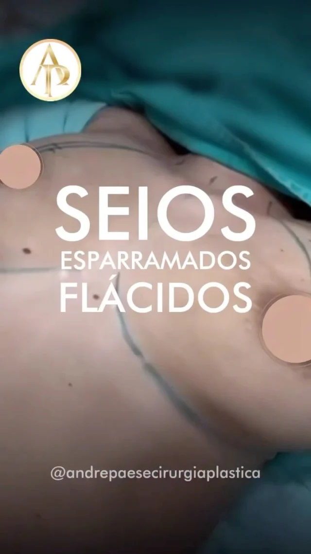 💬 Marque alguém que também sonha com esse procedimento.

Essa paciente sonhava em levantar as mamas e devolver ao corpo a harmonia que o tempo havia mudado.

O Dr. André Paese realizou uma mastopexia com prótese, corrigindo a flacidez, reposicionando as aréolas e devolvendo o volume e a sustentação das mamas.

O resultado? Um colo marcado, seios firmes e o equilíbrio perfeito entre naturalidade e proporção.

Mais do que uma mudança #estetica , é sobre se olhar e se reencontrar com sua nova imagem. 

Dr. André Paese atende e opera em #marabá
