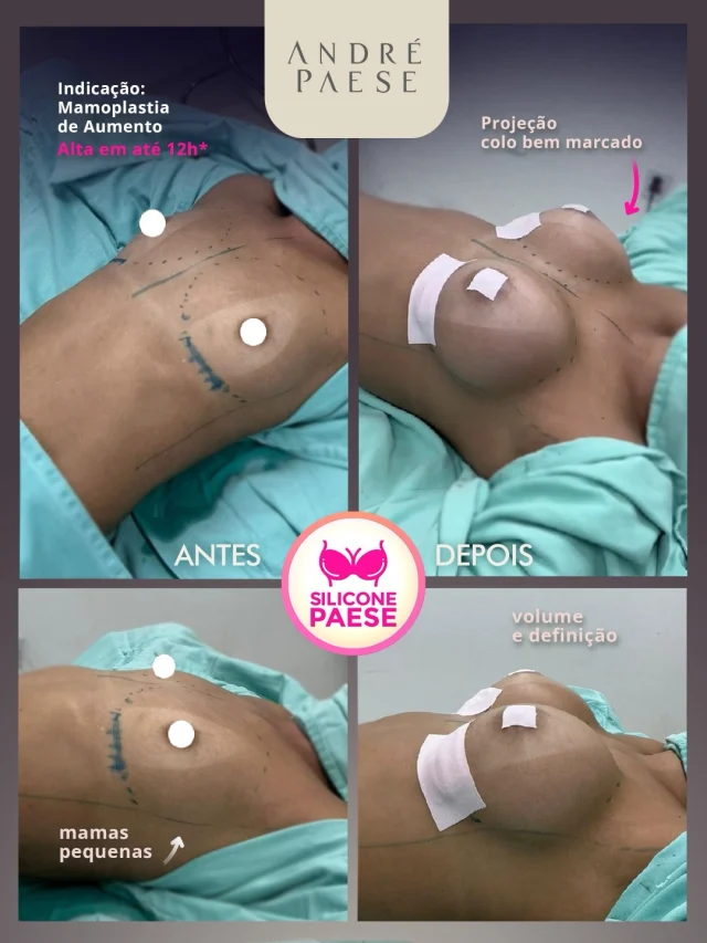 ✅ Dr. André Paese - Cirurgião Plástico. Membro da Sociedade Brasileira de Cirurgia Plástica. 
CRM/PA: 8498 RQE: 5488

Se você deseja colocar próteses de silicone e tem dúvidas sobre a indicação ou sobre como funciona a mamoplastia de aumento, a recuperação rápida, agende uma avaliação presencial ou on-line. É durante a consulta que será possível esclarecer todas as dúvidas e definir o planejamento mais adequado para o seu caso.

✅ Durante a consulta, o Dr. André Paese analisa fatores importantes, como o volume mamário, a presença ou ausência de flacidez, a qualidade dos tecidos, as proporções do corpo e o tamanho e perfil dos implantes mais adequados para cada paciente. Vocês vão conversar sobre todos os seus desejos e expectativas sobre o que esperar do procedimento. Esse planejamento é fundamental para definir a técnica cirúrgica.

Cada organismo responde de maneira diferente e todas as decisões são tomadas com base na avaliação do Dr. André e da equipe médica, priorizando sempre a segurança da paciente.