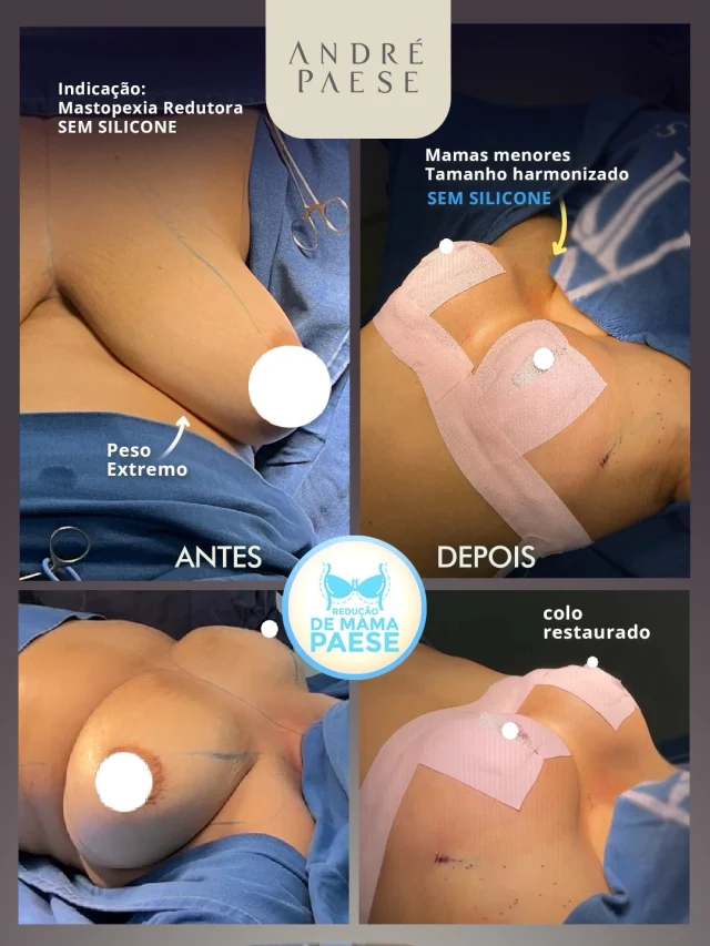 Mamas volumosas podem dificultar exercícios de alto impacto?

Para algumas mulheres, o excesso de volume e peso das mamas pode causar desconforto durante atividades como corrida, saltos e exercícios aeróbicos, além de contribuir para dores nas costas, ombros e região cervical.

A mastopexia redutora (ou redução das mamas sem silicone) pode ser indicada quando o objetivo é reduzir o volume, tratar a flacidez e reposicionar as mamas.

A indicação e a quantidade de redução são individuais e devem ser definidas após avaliação com o Dr. André Paese. 

Dr. André Paese - Cirurgião Plástico. Membro da Sociedade Brasileira de Cirurgia Plástica. 
CRM/PA: 8498 RQE: 5488
