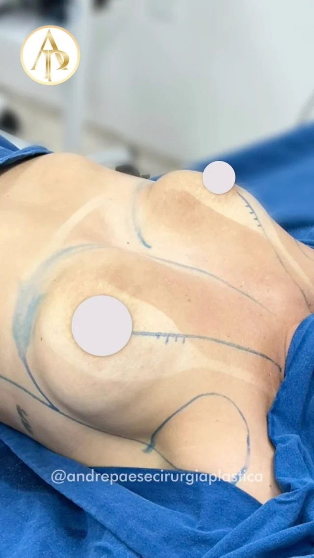 ✅Dr. André Paese - Cirurgião Plástico. Membro da Sociedade Brasileira de Cirurgia Plástica. 
CRM/PA: 8498 RQE: 5488

Mastopexia com prótese: reposicionar, remodelar e dar mais estrutura às mamas.

A mastopexia com prótese pode ser indicada para tratar a flacidez e a queda das mamas, reposicionar as aréolas e, com o uso dos implantes, proporcionar mais volume, projeção, definição e preenchimento do colo.

O planejamento é individualizado, considerando a anatomia, a qualidade dos tecidos, o grau de flacidez e os objetivos de cada paciente.

Cada caso precisa ser avaliado individualmente, e a evolução dos resultados varia de paciente para paciente.