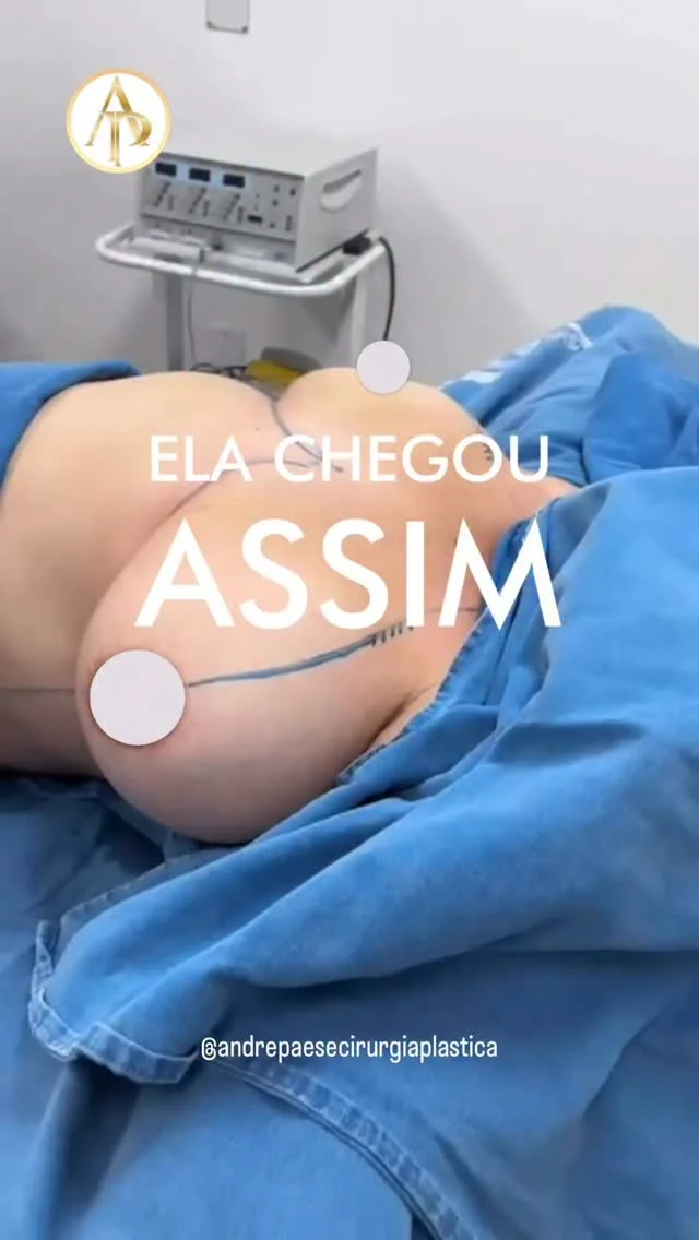 ✅ Dr. André Paese - Cirurgião Plástico. Membro da Sociedade Brasileira de Cirurgia Plástica. 
CRM/PA: 8498 RQE: 5488

Se você sofre com seios muito grandes e pesados, a mamoplastia redutora sem prótese de silicone é a cirurgia que reestrutura as suas mamas utilizando apenas o seu próprio tecido.
Alguns dos benefícios que a técnica busca oferecer:

 * Dores físicas: Elimina o peso excessivo que causa dores intensas na coluna, no pescoço e nos ombros.
 * Marcas nos ombros: Acaba com aquele afundamento doloroso causado pelas alças do sutiã.
 * Assaduras e irritações: Resolve o atrito constante e o suor acumulado na dobra abaixo das mamas.
 * Postura e conforto: Melhora a postura corporal e devolve a liberdade para praticar exercícios físicos.
 * Proporção corporal: Reduz o volume e reposiciona a aréola, criando um formato mais harmônico para o seu corpo.
 
Sem falar que facilita na escolha de sutiãs, biquínis e roupas que antes não serviam ou causavam desconforto.

Cada corpo é único e cada paciente possui sua própria evolução individual no pós-operatório. Agende uma consulta para entender a melhor indicação para o seu caso!

Todo o processo de pré e pós-operatório são explicados com detalhes durante a consulta.