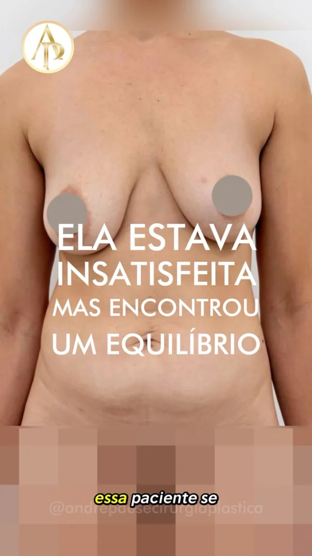 **Mamoplastia de aumento ou mastopexia com prótese?**

👉Procedimentos realizados em ambiente hospitalar com UTI. 

Quando o objetivo é aumentar o volume, melhorar a projeção e o contorno das mamas, **sem flacidez significativa**, a mamoplastia de aumento pode ser uma opção. ( mamoplastia de Aumento = apenas colocar as próteses, os implantes de silicone)

Quando existe **flacidez, queda das mamas ou necessidade de reposicionar as aréolas**, pode haver indicação de mastopexia com prótese, associando o remodelamento dos tecidos ao implante de silicone.

No abdômen, a **abdominoplastia** pode ser indicada quando há excesso de pele flácida e frouxa e/ou presença de **diástase dos músculos abdominais**. O procedimento permite remover o excesso de pele e, quando necessário, corrigir a diástase, buscando melhorar o contorno abdominal.

**A indicação depende da anatomia e das necessidades de cada paciente e deve ser definida após avaliação médica.**

✅ Dr. André Paese - Cirurgião Plástico. Membro da Sociedade Brasileira de Cirurgia Plástica. 
CRM/PA: 8498 RQE: 5488