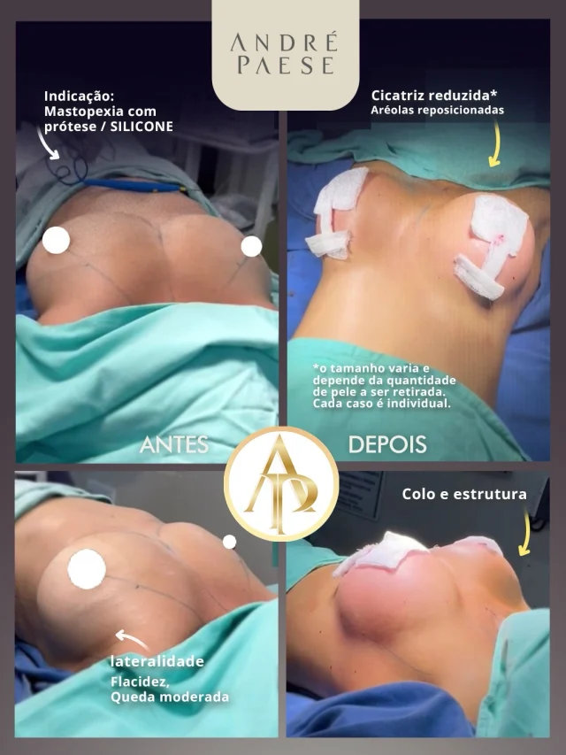 Qual será o tamanho da cicatriz na mastopexia com prótese?

Essa é uma dúvida muito comum, mas não existe um único tamanho de cicatriz para todas as pacientes.

Na mastopexia, é necessário remover o excesso de pele e reposicionar os tecidos e as aréolas. Por isso, a extensão da cicatriz está diretamente relacionada ao grau de flacidez e à quantidade de pele que precisa ser retirada.

Dependendo do caso, a cicatriz pode ficar apenas ao redor da aréola, estender-se verticalmente até o sulco mamário ou também incluir uma cicatriz horizontal no sulco, formando o conhecido “T invertido”.

A presença da prótese não significa, por si só, que será possível fazer uma cicatriz menor. O implante contribui com volume, projeção e estrutura, enquanto a quantidade de pele excedente é que ajuda a determinar a extensão necessária da mastopexia.

Durante a avaliação, é possível analisar a anatomia e explicar qual cicatriz provavelmente será necessária para cada caso.

A aparência final da cicatriz também apresenta evolução individual e depende de fatores próprios de cicatrização, cuidados pós-operatórios e do tempo.

✅ Dr. André Paese - Cirurgião Plástico. Membro da Sociedade Brasileira de Cirurgia Plástica. 
CRM/PA: 8498 RQE: 5488