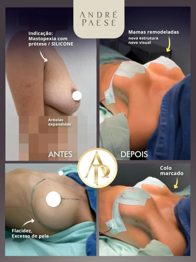 Mastopexia com prótese: onde o implante pode ser posicionado?

Imagens ilustrativas - objetivo informativo e educacional.

Na mastopexia com prótese, além de remover o excesso de pele e remodelar as mamas, o planejamento também envolve definir em qual plano o implante será colocado.

No plano subglandular, a prótese fica atrás da glândula mamária e à frente do músculo peitoral.

Já no plano submuscular, o implante é posicionado atrás do músculo peitoral, proporcionando maior cobertura do implante na região superior.

‼️Mas qual é o melhor? Não existe uma única resposta. A escolha depende da anatomia, da quantidade e qualidade dos tecidos, das características das mamas, do implante e dos objetivos de cada paciente.

Por isso, tamanho, perfil e posicionamento da prótese fazem parte de um planejamento individualizado, definido após avaliação médica.

✅ Dr. André Paese - Cirurgião Plástico. Membro da Sociedade Brasileira de Cirurgia Plástica. 
CRM/PA: 8498 RQE: 5488
