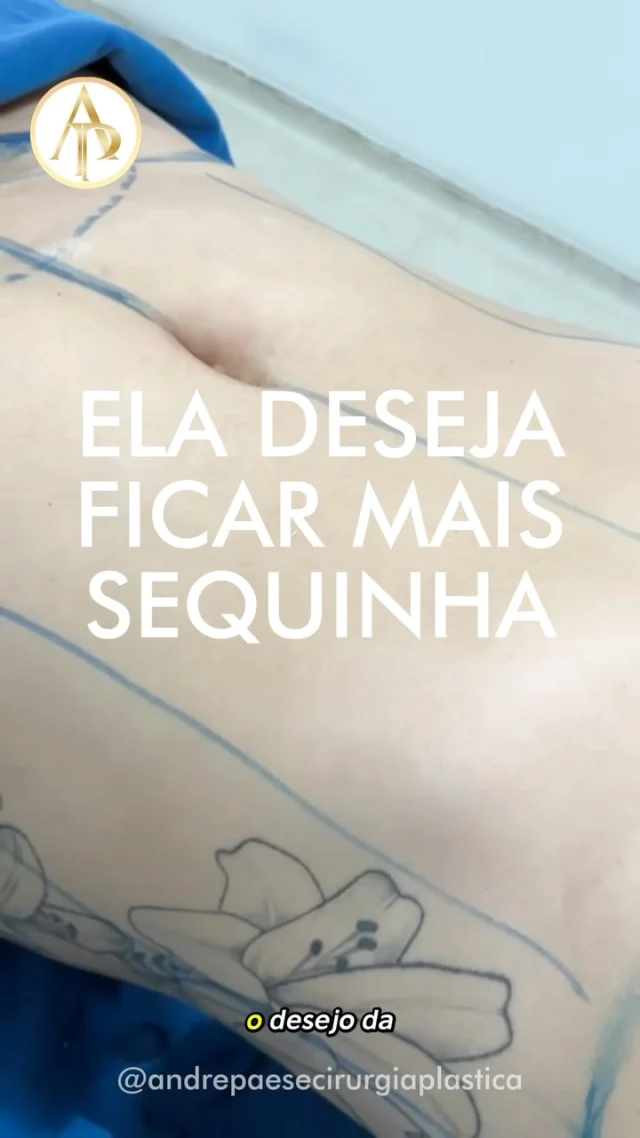 Lipoescultura + Abdominoplastia: tratando o abdômen e o contorno corporal

A associação dos procedimentos permite trabalhar diferentes aspectos do abdômen em um mesmo planejamento cirúrgico.

A abdominoplastia trata principalmente o excesso de pele e a flacidez abdominal e, quando há indicação, permite também a correção da diástase. Já a lipoescultura atua sobre depósitos de gordura localizada, ajudando a definir regiões como cintura e flancos e a aprimorar o contorno corporal.

Mais do que simplesmente “retirar pele e gordura”, o objetivo é planejar abdômen, cintura e proporções corporais de forma integrada.

A indicação da associação, assim como a extensão de cada procedimento, depende da anatomia, das condições clínicas e dos objetivos de cada paciente. Os resultados e sua evolução são individuais. 

Evolução da  paciente é individual. Cada corpo é único.