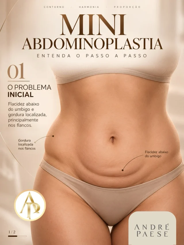 Mini abdominoplastia: quando o excesso de pele está concentrado abaixo do umbigo

Nem toda flacidez abdominal exige uma abdominoplastia convencional. Em casos selecionados, quando o excesso de pele está predominantemente na região inferior do abdômen, a mini abdominoplastia pode ser uma possibilidade.

O procedimento permite remover o excesso de pele dessa região e, quando indicado, pode ser associado à lipoaspiração dos flancos e da cintura, buscando melhorar o contorno corporal. Em alguns casos, também pode ser realizada a correção da diástase na região inferior do abdômen.

Por ser uma cirurgia mais limitada, não substitui a abdominoplastia convencional quando existe flacidez importante acima do umbigo.

A escolha entre mini abdominoplastia e abdominoplastia completa depende da distribuição da flacidez, da quantidade de pele, da presença de gordura localizada e das características do abdômen de cada paciente.

O planejamento é sempre individualizado e definido após avaliação médica.

Dr. André Paese - Cirurgião Plástico. Membro da Sociedade Brasileira de Cirurgia Plástica. 
CRM/PA: 8498 RQE: 5488