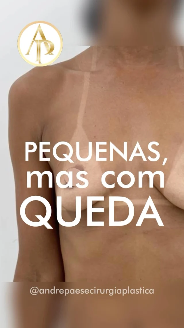 Dr. André Paese - Cirurgião Plástico. Membro da Sociedade Brasileira de Cirurgia Plástica. 
CRM/PA: 8498 RQE: 5488

✅Mamas pequenas também podem precisar de mastopexia com prótese.

Muitas pacientes acreditam que, por terem pouco volume mamário, colocar o implante é suficiente. Mas o tamanho da mama é apenas um dos pontos que avaliamos.

Quando existe flacidez, excesso de pele ou queda da mama e da aréola, somente aumentar o volume pode não proporcionar o formato desejado. Em alguns casos, é necessário também reposicionar e remodelar os tecidos — e é aí que a mastopexia pode fazer parte do planejamento.

Durante a consulta, avaliamos a qualidade e quantidade de pele, posição das aréolas, formato das mamas, assimetrias, proporções do tórax e o resultado que a paciente deseja alcançar.

A partir dessa avaliação é possível definir se o mais indicado para aquele caso é apenas o aumento com implantes ou uma mastopexia associada à prótese.

Não é apenas uma questão de tamanho. É sobre escolher a técnica adequada para a anatomia e os objetivos de cada paciente.

A indicação é sempre individualizada após avaliação médica.