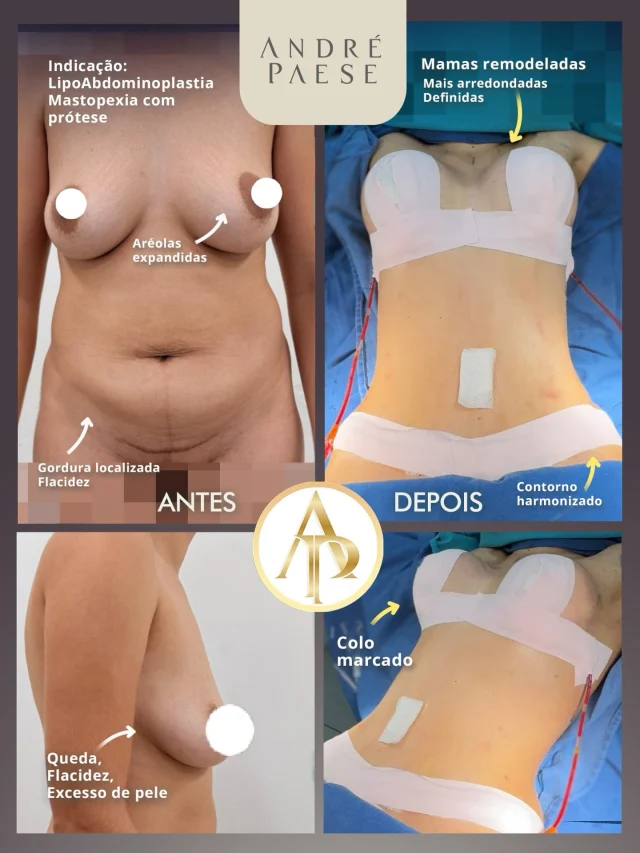 Lipoabdominoplastia + Mastopexia com Prótese: quando podemos combinar?

Quando as queixas envolvem tanto o abdômen quanto as mamas, em alguns casos é possível planejar os procedimentos de forma associada.

Na região abdominal, a lipoabdominoplastia permite tratar o excesso de pele, a flacidez e a gordura localizada, além de melhorar o contorno da cintura.

Já nas mamas, a mastopexia com prótese busca reposicionar e remodelar os tecidos, corrigir a flacidez e, quando indicado, utilizar o implante para proporcionar o volume e a projeção desejados.

✅ Mas realizar esses procedimentos juntos não é uma decisão automática. Durante a consulta, avaliamos a anatomia da paciente, seu estado de saúde, a extensão de cada cirurgia e o tempo cirúrgico previsto para definir o planejamento mais adequado e seguro.

O objetivo é olhar para o corpo como um todo, buscando equilíbrio e proporção, sempre respeitando as características e os limites de cada paciente.

Tudo começa durante a avaliação com o Dr. André Paese. 

⁉️HOJE O QUE MAIS TE INCOMODA?