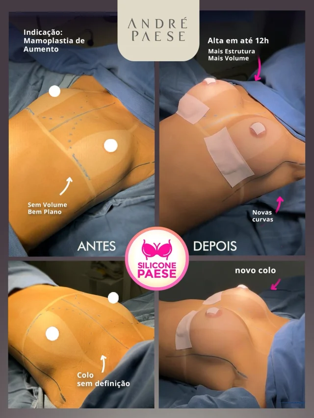 Mamoplastia de aumento com recuperação rápida: cirurgia em torno de 30 minutos e alta em até 12h* - Procedimento realizado no Hospital com Equipe Médica especializada e UTI.

Em casos selecionados, o procedimento pode durar aproximadamente 30 minutos, e a paciente pode receber alta em até 12 horas após a cirurgia, liberada após avaliação criteriosa da equipe.

A proposta não é “acelerar” a recuperação, e sim conduzir cada etapa com segurança e acompanhamento adequado.

Cada paciente evolui de uma forma diferente.
Todo planejamento é individual e pode variar conforme a anatomia, a técnica utilizada e as condições clínicas de cada caso.

*Tempo cirúrgico aproximado e alta em até 12 horas dependem da avaliação individual e da evolução da paciente.

Dr. André Paese - Cirurgião Plástico. Membro da Sociedade Brasileira de Cirurgia Plástica. 
CRM/PA: 8498 RQE: 5488