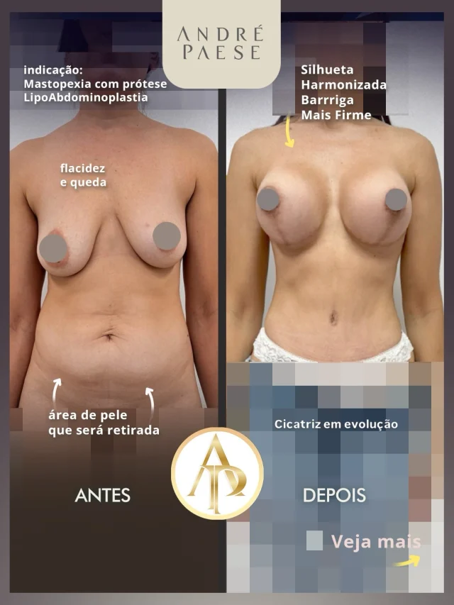 Essa paciente combinou procedimentos nas mamas e no contorno corporal, dentro de um planejamento pensado especialmente para o caso dela.

Na consulta, o Dr. André Paese escuta as principais queixas, entende os desejos da paciente e avalia o que é possível realizar com segurança, respeitando a anatomia, as condições clínicas e os objetivos de cada pessoa.

Nem toda combinação é indicada para todas as pacientes. Por isso, o mais importante é alinhar expectativas e possibilidades de forma individualizada.

Cada plano cirúrgico é único. O objetivo é construir uma estratégia que faça sentido para aquela paciente, e não simplesmente somar procedimentos.

Sobre a cicatrização: 

A cicatrização é um processo gradual e individual. Cada organismo responde de uma forma, e a aparência da cicatriz vai se modificando ao longo dos meses.

No início, ela pode apresentar uma coloração mais evidente, mas com o tempo tende a amadurecer e clarear progressivamente.

Por isso, o acompanhamento nos retornos faz parte do pós-operatório. Em alguns casos, podem ser indicados cuidados específicos ao longo da evolução para acompanhar esse processo da melhor forma possível.

Paciência também faz parte do resultado. A cicatriz não deve ser avaliada apenas nas primeiras semanas: sua evolução acontece com o tempo e varia de paciente para paciente.