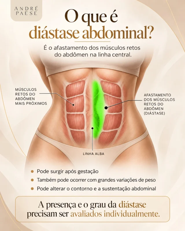 O que é diástase abdominal?

A diástase abdominal é o afastamento dos músculos retos do abdômen na linha central.

Ela pode surgir após a gestação, grandes variações de peso ou mudanças importantes na parede abdominal, e pode influenciar o contorno e a sustentação da região.

Nem toda diástase é igual. A distância entre os músculos, a qualidade dos tecidos e as características de cada paciente precisam ser avaliadas individualmente.

O diagnóstico e a indicação de tratamento dependem de avaliação médica.

O que é plicatura abdominal?

A plicatura abdominal é a técnica utilizada para aproximar novamente os músculos retos do abdômen quando existe indicação de correção da diástase.

Por meio de suturas, a parede abdominal é reforçada na linha central, contribuindo para a sustentação e para o planejamento do contorno abdominal.

A necessidade da plicatura depende da anatomia de cada paciente e do grau de afastamento muscular.

Cada caso precisa ser avaliado individualmente para definir a técnica mais adequada.

Abdominoplastia + correção da diástase: mais do que retirar excesso de pele

Essa paciente apresentava flacidez abdominal, excesso de pele e também diástase dos músculos retos do abdômen.

Durante a abdominoplastia, além da retirada do excesso de pele, foi realizada a plicatura abdominal, técnica utilizada para aproximar novamente a musculatura na linha central quando existe indicação.

Com esse planejamento, é possível atuar em diferentes pontos do abdômen:

* reduzir o excesso de pele e a flacidez;
* corrigir a diástase quando presente;
* melhorar a sustentação da parede abdominal;
* favorecer um contorno abdominal mais organizado e proporcional.

Cada abdômen apresenta características diferentes, por isso a necessidade da plicatura e a extensão da abdominoplastia são definidas de forma individual durante a avaliação.

Não é apenas retirar pele. É entender o que está acontecendo com cada estrutura do abdômen e planejar o tratamento de forma individualizada.