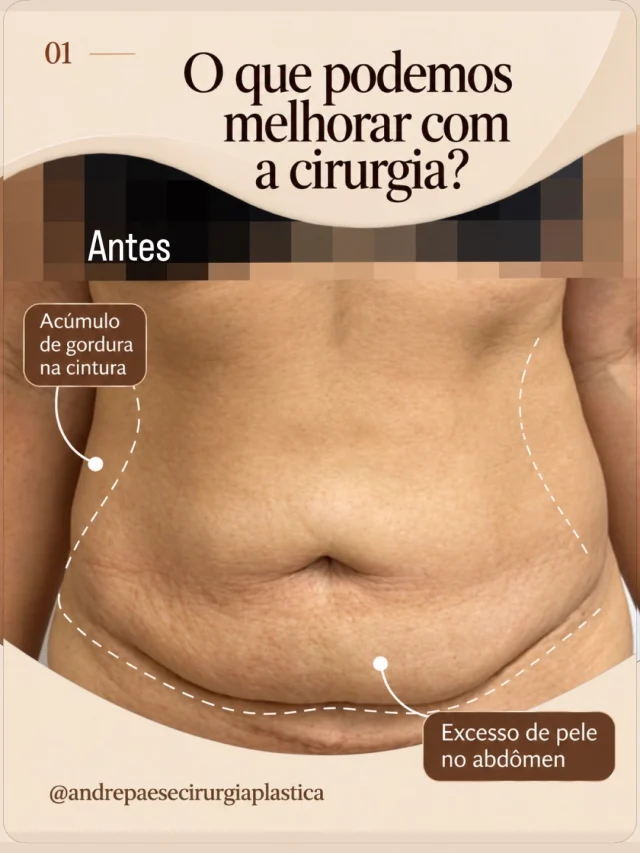 🚨Nem sempre a gordura localizada é a única responsável pelo contorno abdominal. 

Em muitos casos, além do acúmulo de gordura na cintura, também existe um excesso de pele que pode influenciar o formato do abdômen.

E é justamente por isso que cada cirurgia precisa de um planejamento individualizado!

🔸 Lipoaspiração: atua na remoção da gordura localizada, ajudando a definir a cintura e melhorar o contorno corporal.

🔸 Abdominoplastia: permite retirar o excesso de pele abdominal e, quando necessário, corrigir a diástase dos músculos retos do abdômen.

Quando indicadas em conjunto, essas técnicas se complementam, proporcionando um contorno abdominal mais harmônico e adequado às características de cada paciente.

O segredo está em entender o que realmente precisa ser tratado. 

Cada corpo tem suas particularidades, e a avaliação individualizada é fundamental para definir a melhor abordagem.

✅ Dr. André Paese | Cirurgia Plástica - Membro da Sociedade Brasileira de Cirurgia Plástica. CRM/PA: 8498 RQE: 5488

#Abdominoplastia #Lipoaspiração #ContornoCorporal