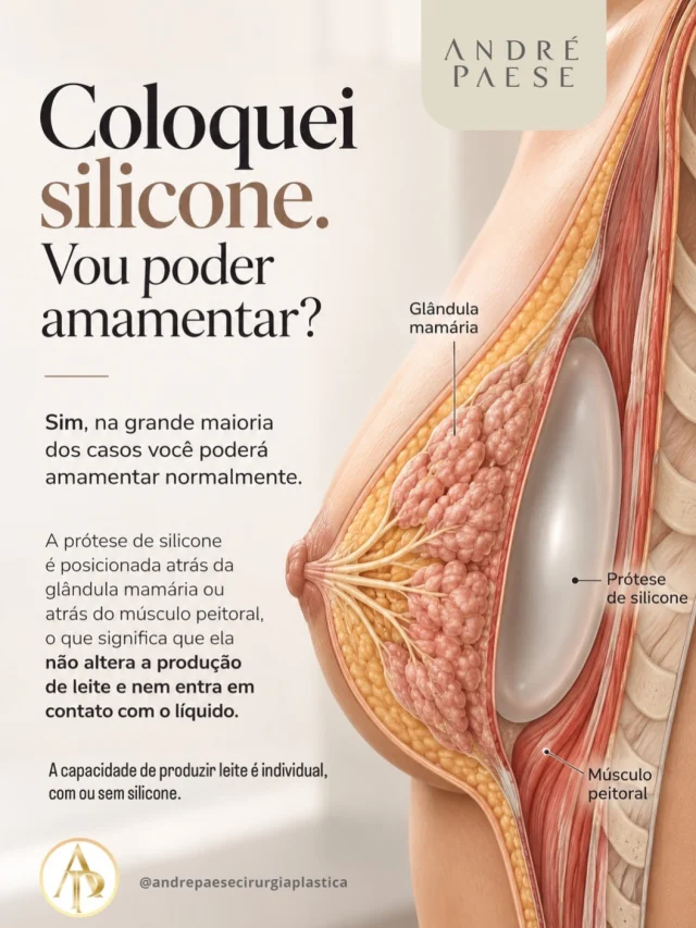🤱🏼 Quem colocou silicone pode amamentar?

Sim! Na maioria dos casos, a amamentação é possível após a colocação dos implantes mamários.

A prótese fica posicionada atrás da glândula mamária ou do músculo peitoral, sem contato direto com o leite materno.

💕 Vale lembrar: a capacidade de produzir leite é individual, com ou sem silicone.

✅Converse com o Dr. André Paese, ele vai te ajudar.

CRM/PA: 8498 RQE: 5488