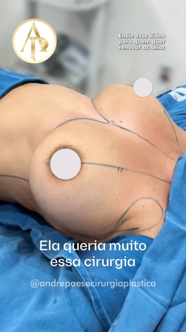 Redução de mama sem silicone!

O desejo dessa paciente era melhorar a harmonia e o formato das mamas, preservando sua naturalidade e sem utilizar próteses de silicone.

✅ Após uma avaliação individualizada com o Dr. André Paese, foi possível indicar e realizar a redução mamária sem implantes, respeitando suas características e expectativas.

Cada caso é único! A avaliação médica é fundamental para definir a técnica mais adequada às necessidades e aos objetivos de cada paciente.

Dr. André Paese - Cirurgião Plástico. Membro da Sociedade Brasileira de Cirurgia Plástica. 
CRM/PA: 8498 RQE: 5488

Marabá - Pará - Brasil