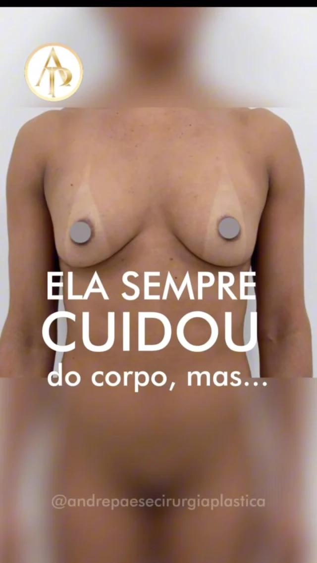 ‼️Flacidez mamária: é possível recuperar o formato e a definição dos seios?

Com o passar do tempo, alterações de peso, gestação e fatores hormonais, as mamas podem perder volume, firmeza e definição.

Os implantes de silicone podem ajudar a recuperar o volume, proporcionar maior projeção e valorizar o contorno das mamas, especialmente quando a flacidez é discreta.

Quando existe excesso de pele ou queda mais acentuada, pode ser indicada a mastopexia com prótese, que combina a remodelação e elevação das mamas com o volume do silicone.

✅Converse com o Dr. André Paese! Cada mama possui características próprias, e uma avaliação individual é fundamental para definir o procedimento mais adequado aos seus objetivos.